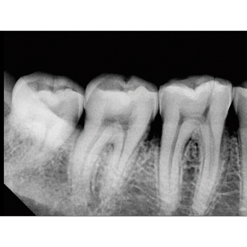 Vatech EzRay Air Wall - высокочастотный настенный дентальный рентген