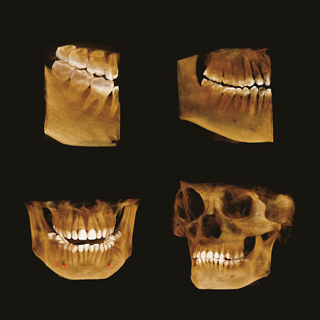 GENORAY Papaya 3D 23x14 - компьютерный томограф 
