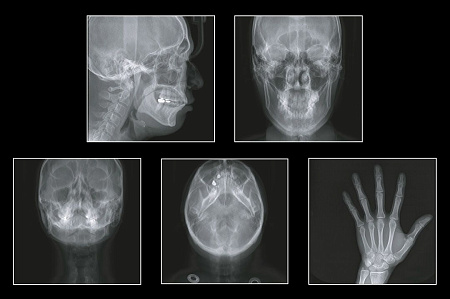 GENORAY Papaya 3D 23x14 - компьютерный томограф с цефалостатом One Shot 