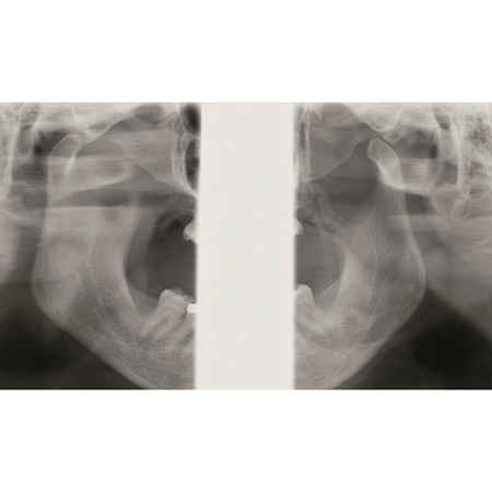 KaVo Pan eXam Plus 3D Ceph - универсальный датчик Pan/Ceph для панорамной томографии, цефалостат, функция 3D-томографии 6x8 см