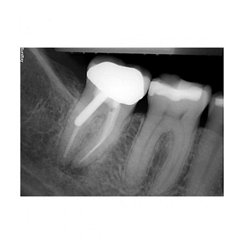 Suni SuniRay2 - система компьютерной радиовизиографии